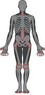 Polyarthritis латынь
