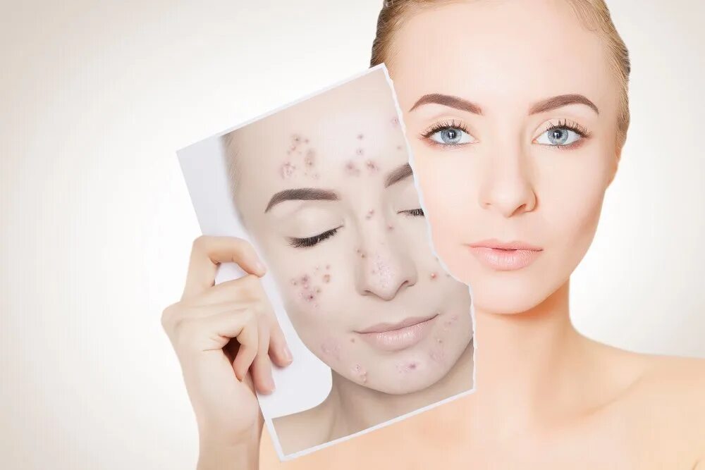 Биоаква крем от прыщей. Breylee acne treatment serum. Cares acne skin care. Девушка с проблемной кожей. Лицо девушки с проблемной кожей.