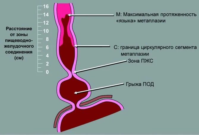 Пищевод Барретта классификация. Циркулярный сегмент пищевода. Критерии пищевода Барретта.