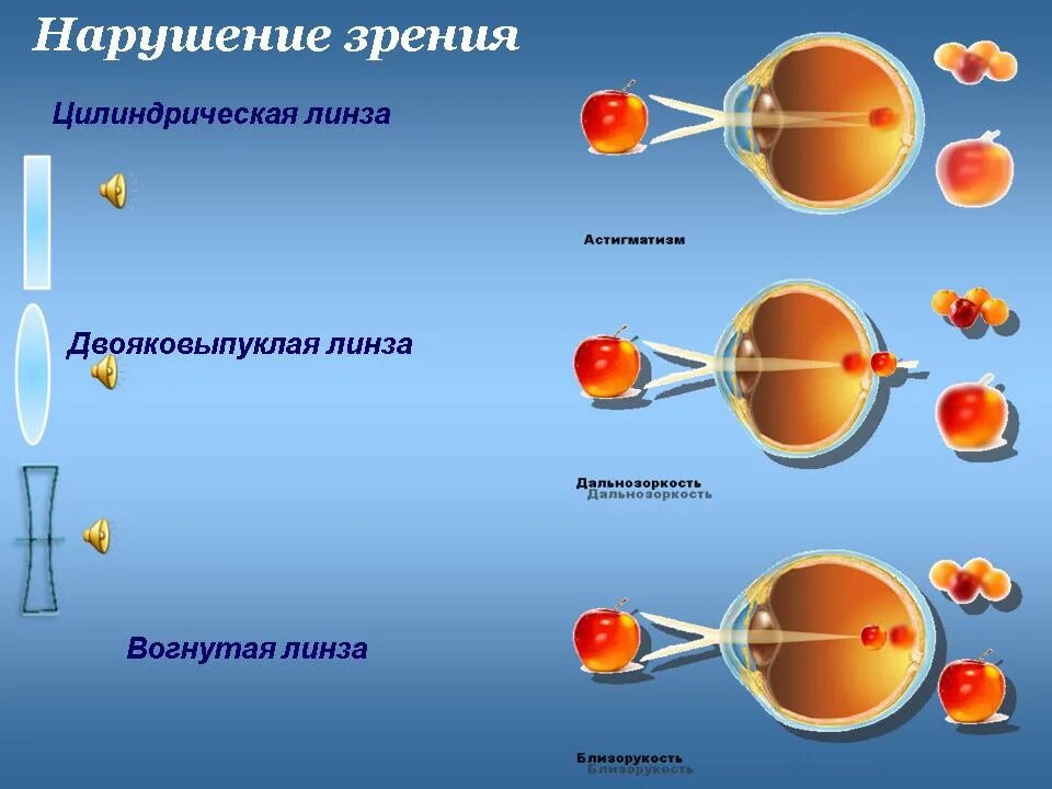 Линзы для близорукости двояковыпуклые. Нарушение зрения биология. Двояковыпуклая линза для дальнозоркости. Типы нарушения зрения. Линзы для зрения дальнозоркость