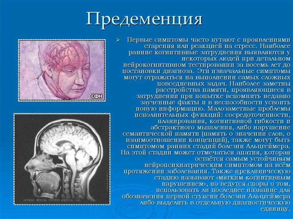 Синильная деменция. Болезнь Альцгеймера. Болезнь Альцгеймера деменция. Болезнь Альцгеймера симптомы. Болезнь Альцгеймера ранняя стадия.