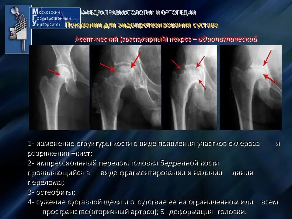 Коксартроз к какому врачу обратиться. Импиджмент тазобедренного сустава. Эндопротез плечевого сустава Тотальный реверсивный. Суставная щель тазобедренного сустава рентген. Ширина суставной щели тазобедренного сустава 3 мм.