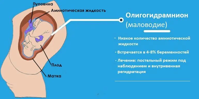 Многоводие в 3 триместре. Плод в амниотической жидкости. Осложнения многоводия. Амнион и околоплодные воды.