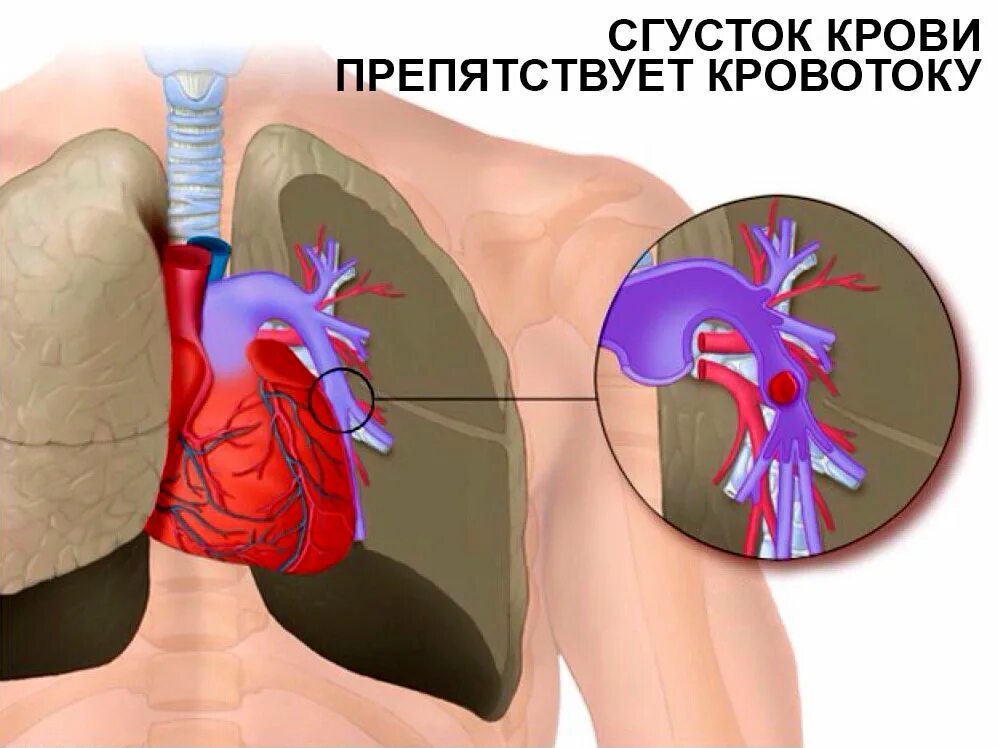 Тромб в желудочке