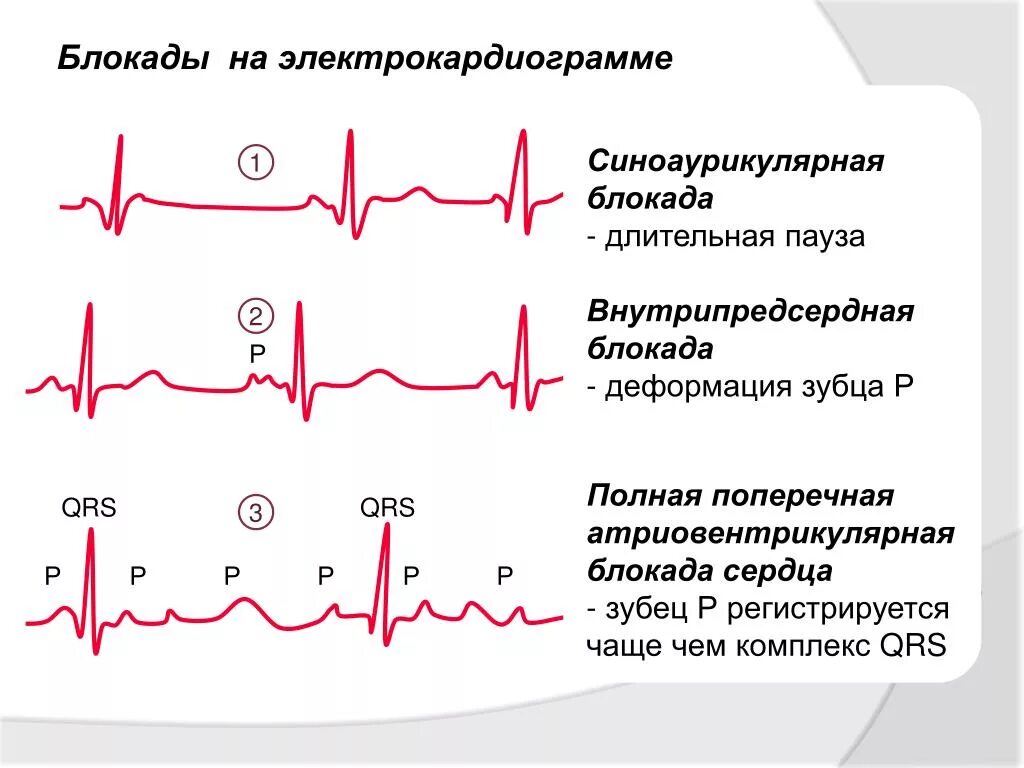 Блокада правого желудочка. ЭКГ при нарушении проводимости (блокады). Как выглядит блокада на ЭКГ. ЭКГ при поперечной блокаде. Блокады на ЭКГ расшифровка.