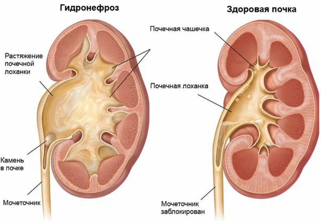 Почему увеличена почка