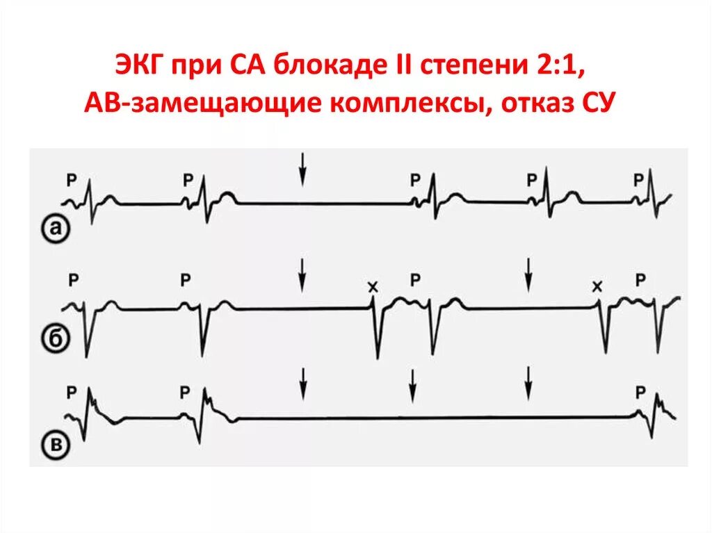 Са блокада 1 степени. Синоатриальная блокада Мобитц 1 ЭКГ. Са блокада 1 степени на ЭКГ. Синоатриальная блокада 1 степени на ЭКГ. Синоатриальная блокада 2 степени на ЭКГ.