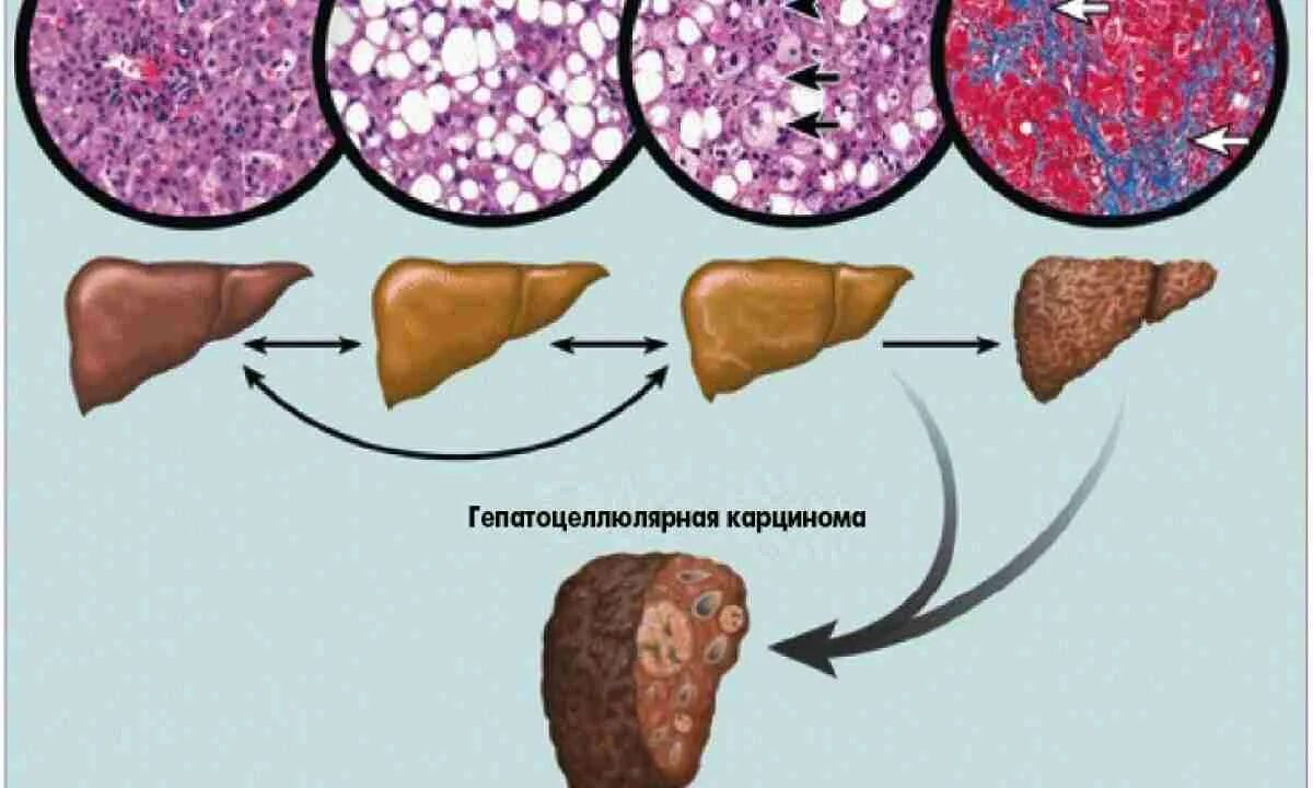 Диффузный гепатоз печени что это такое. Неалкогольный жировой гепатоз печени. стеатоз печени патанатомия. жировая дистрофия печени (стеатоз печени).