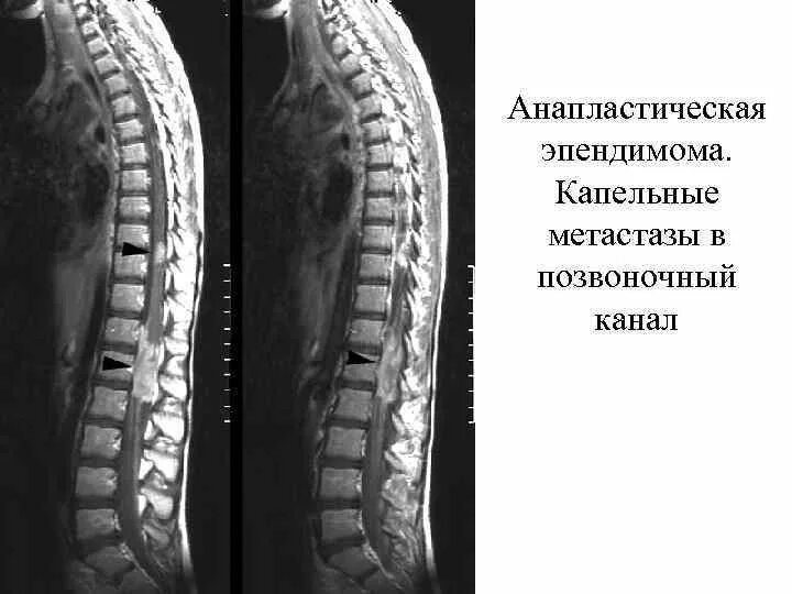 Эпендимома спинного. Эпендимома конского хвоста спинного мозга. Астроцитома спинного мозга мрт. Пластическая аппендимома. Опухоль спинного мозга эпендимома.