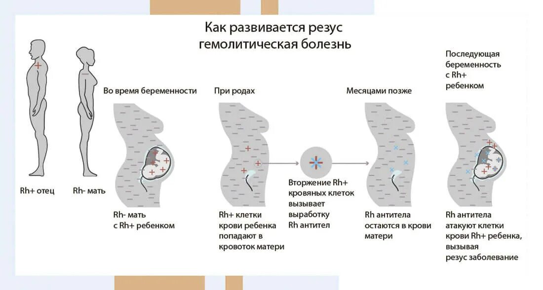 Резус конфликт при беременности что это значит. Последовательность стадий развития резус- конфликта. Схема резус конфликт при беременности. Конфликт по резус фактору при беременности. Механизм развития резус конфликта.