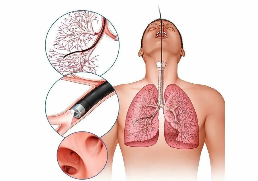 Бронхоальвеолярный лаваж. Тотальный бронхоальвеолярный лаваж. Бронхоскопический лаваж. Обструктивный бронхит бронхоскопия. Рак поддается лечению