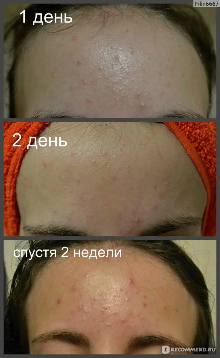 Какие продукты есть от прыщей. Что не есть чтобы не было прыщей. что нельзя есть чтобы не появлялись прыщи. что не нужно есть чтобы не было прыщей. что нельзя кушать чтобы не появилось прыщей.