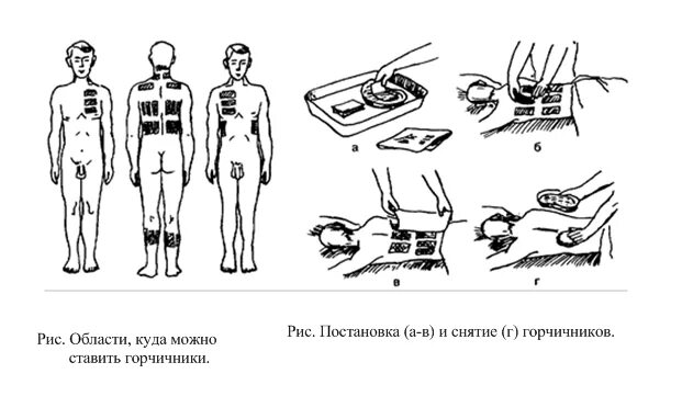 Сколько раз ставить горчичники. Места постановки горчичников при кашле. Схема постановки горчичников при пневмонии. Горчичники при кашле с мокротой. Схема размещения горчичников.