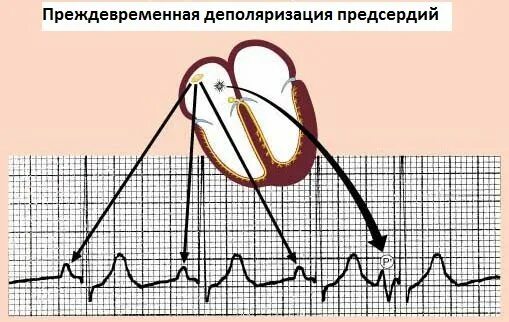 Преждевременная деполяризация желудочков. Преждевременная деполяризация желудочков на экг. реполяризация предсердий на экг. ранняя реполяризация предсердий. преждевременная деполяризация предсердий.