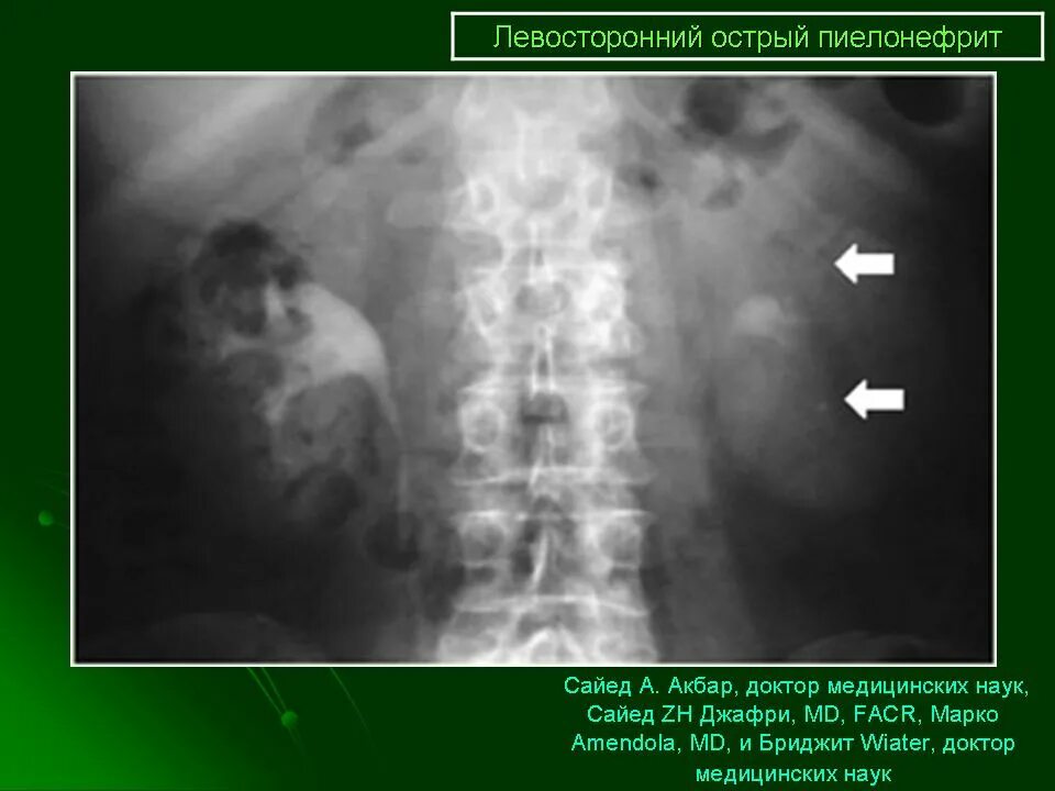 Острый пиелонефрит экскреторная урография. Острый пиелонефрит обзорная урография. Хронический пиелонефрит урография. Хронический пиелонефрит экскреторная урография.