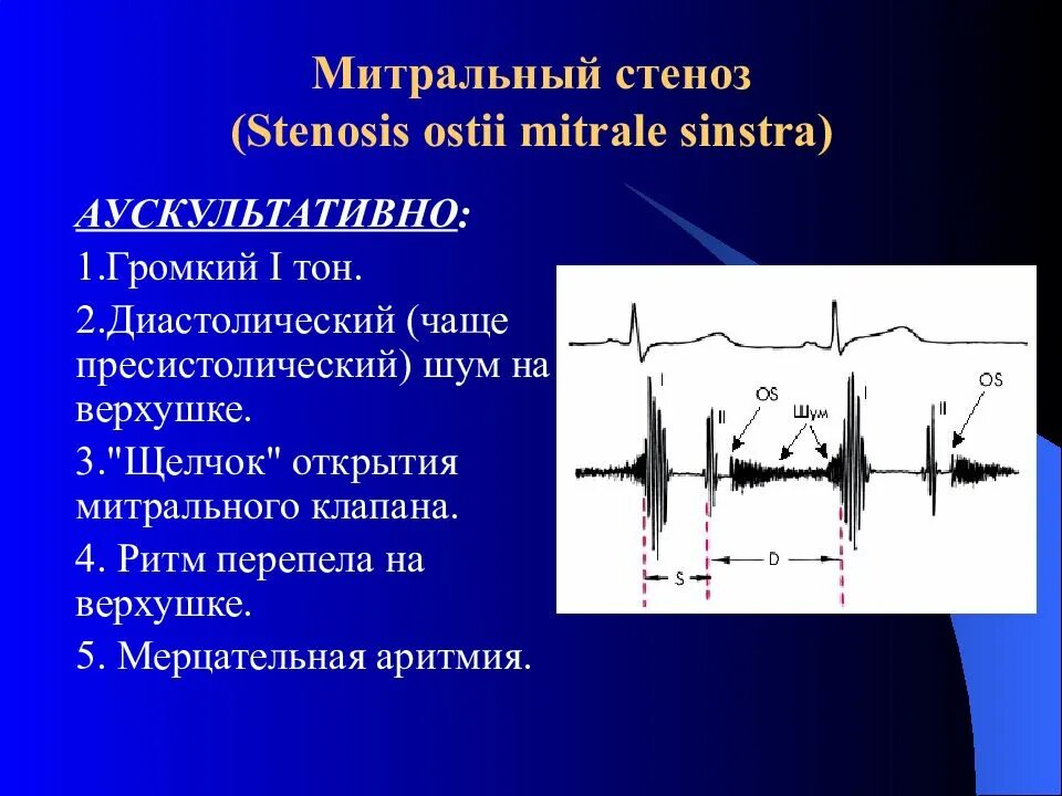 При митральном стенозе наблюдается