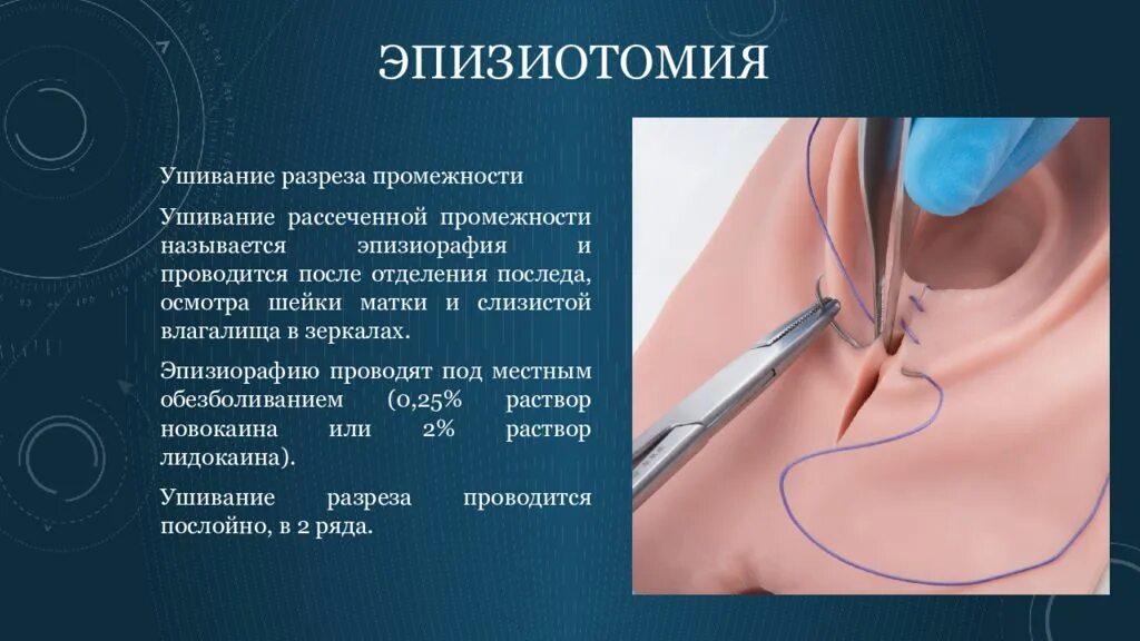Картинки ЛАТЕРАЛЬНАЯ ЭПИЗИОТОМИЯ