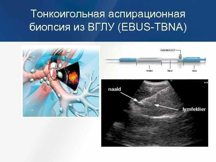 Узи тонкоигольная биопсия. Тонкоигольная аспирационная пункционная биопсия. трансторакальная аспирационная биопсия. трансбронхиальная пункционная биопсия. биопсия внутригрудных лимфатических узлов.