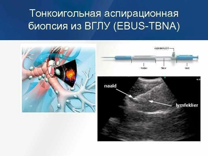 Биопсия легких как проводится. Трнсбронхиальная рункцтя лимфоущлов. Тонкоигольная аспирационная пункционная биопсия. Биопсия внутригрудных лимфатических узлов как проводится. Трансбронхиальная пункционная биопсия.