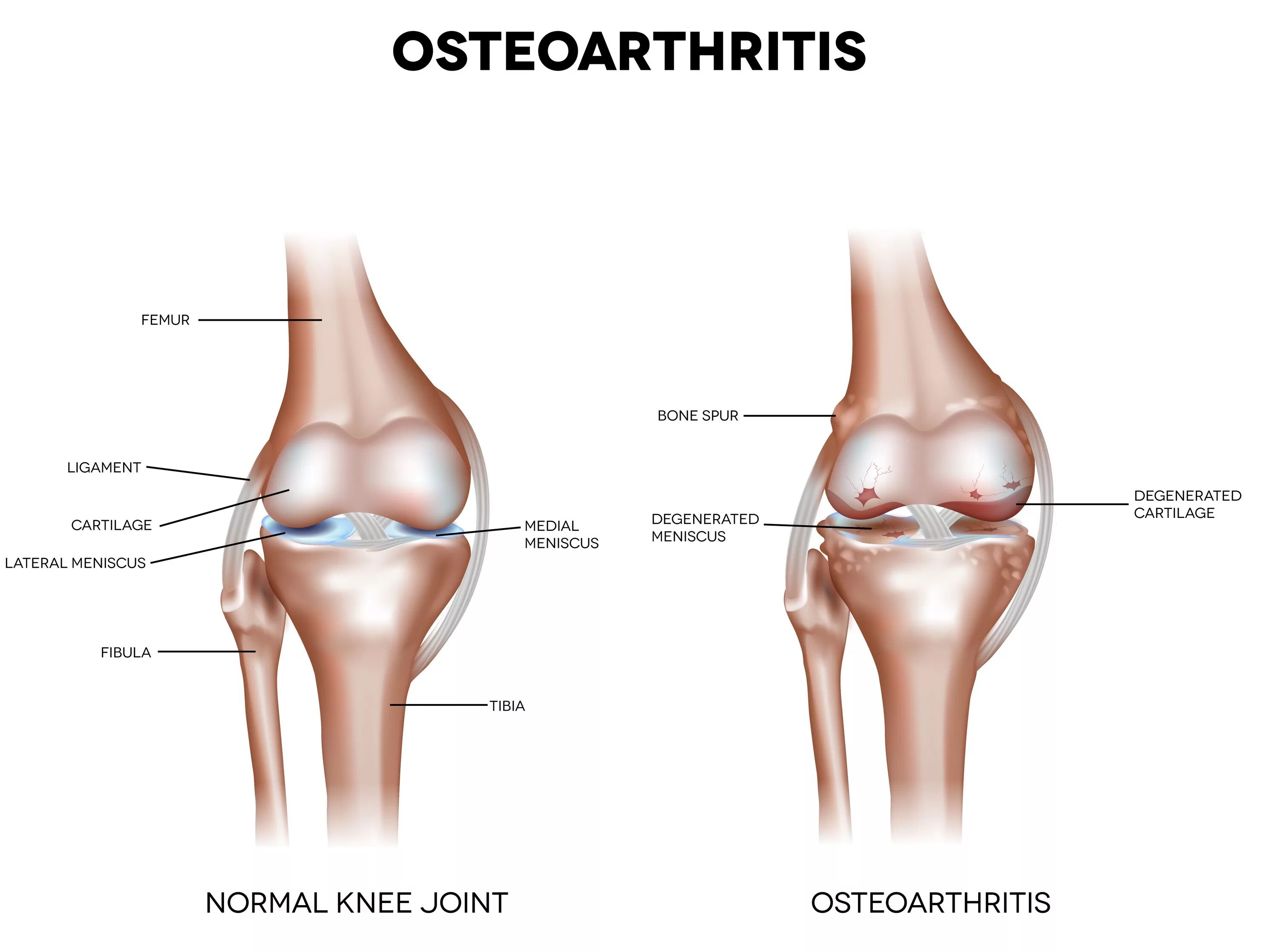 Артроз коленного сустава мениск. Остеоартрит коленного сустава. Остеоартрит коленного сустава синдромы. Коленный сустав анатомия артроз. Разрушение хряща коленного сустава.