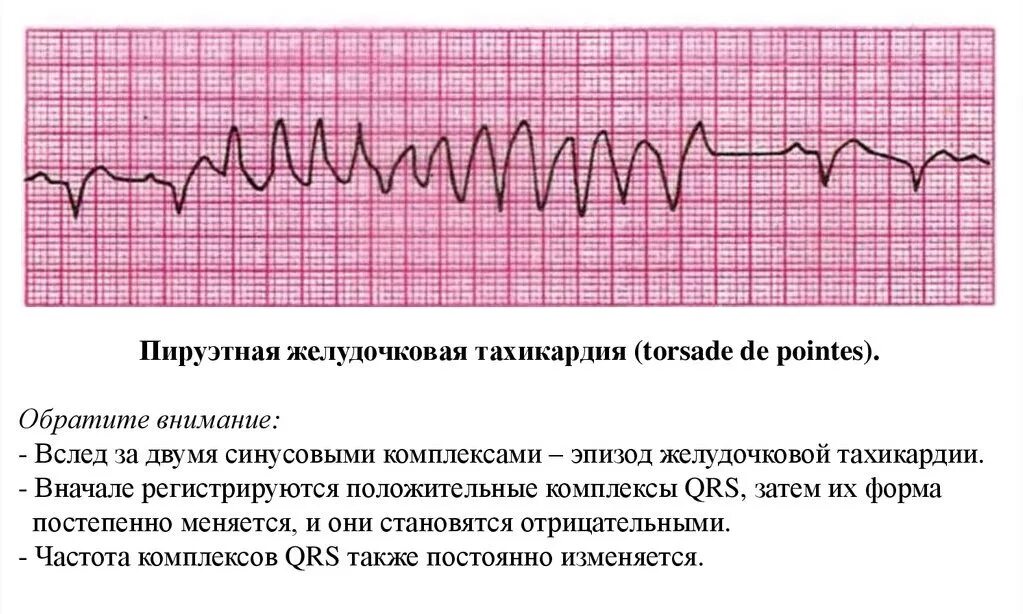 Желудочковая тахикардия на экг. Пируэтная тахикардия ЭКГ. Пируэтная желудочковая тахикардия ЭКГ. Полиморфная желудочковая тахикардия ЭКГ. Пароксизмальная желудочковая тахикардия на ЭКГ.