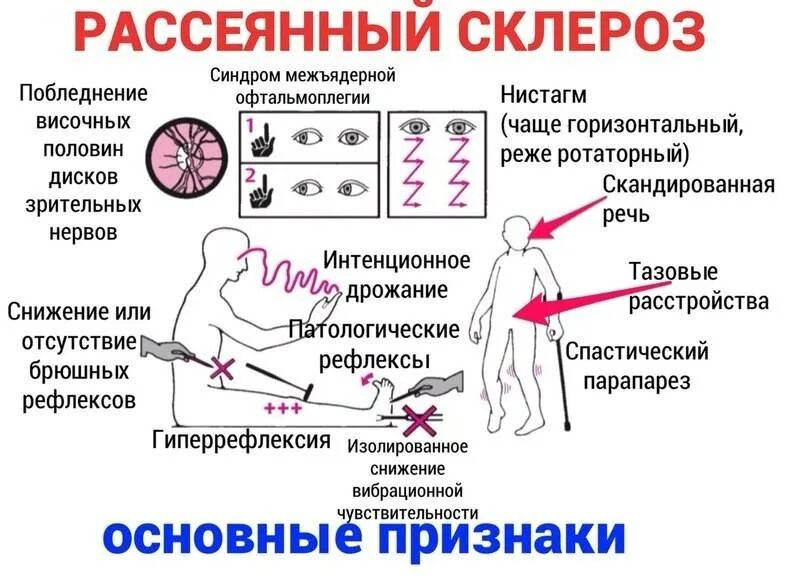 Рассеянный склероз. Рассеянный склероз симптомы. Симптомы рассеянного склероза. Клинические проявления рассеянного склероза.