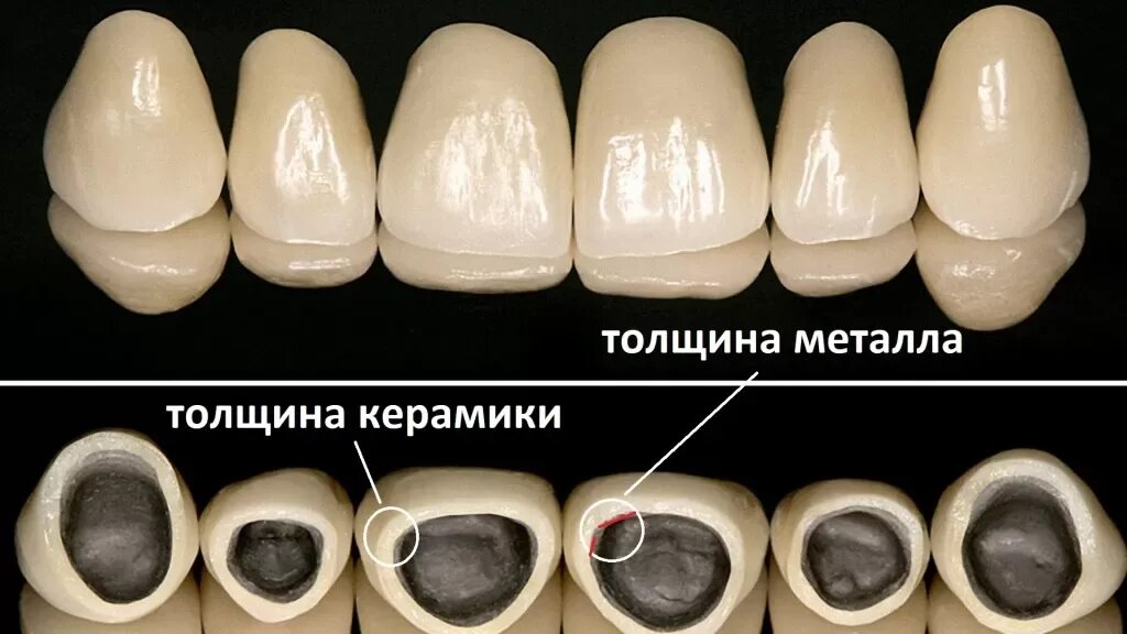 Сколько изготавливается коронка. Металлокерамическая коронка а1 120. Металлокерамическая коронка Ceramco. Слои металлокерамической коронки. Металлокерамическая коронка (стандарт).