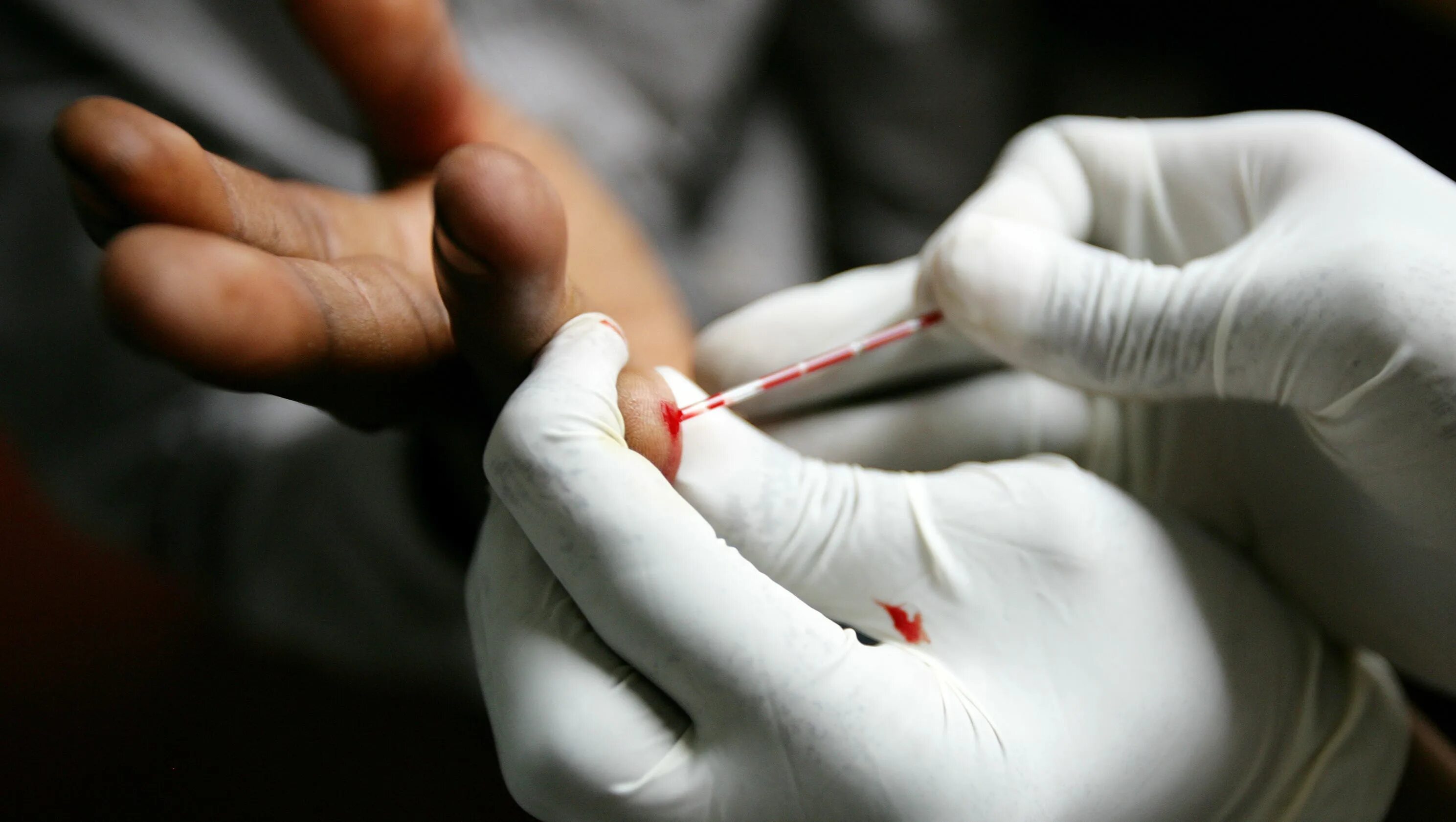 Вич инфицированные тест. HIV Test. Фото ВИЧ инфицированных. Эпидемия ВИЧ.
