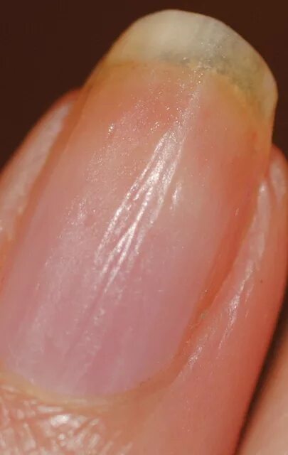 Продольные бороздки на ногтях. Продольные полосы на ногтях. Вертикальные полосы на ногтях. Продольные и поперечные борозды на ногтях.