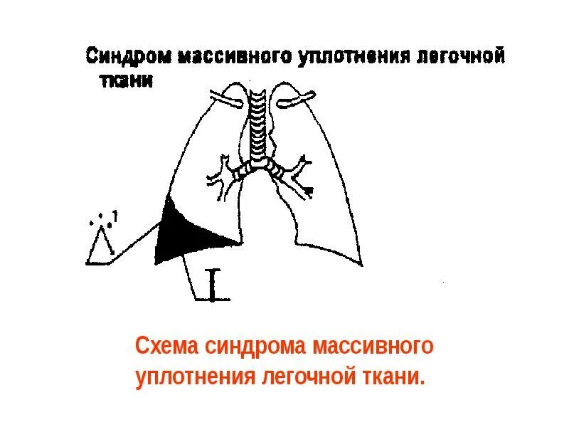 Синдром уплотнения ткани. Патогенез уплотнения легочной ткани. синдром нормальной легочной ткани. синдром массивного уплотнения легочной ткани. синдром повышенной воздушности легочной ткани схема.