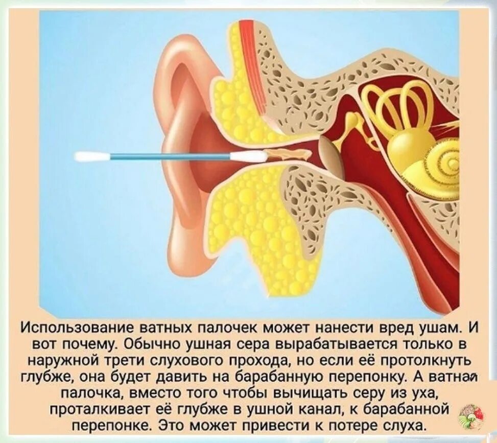 Заложило ухо ватной палочкой что делать. Как правильно чистить уши. Как правильно чимститьуши. Чистка ушей ватными палочками.