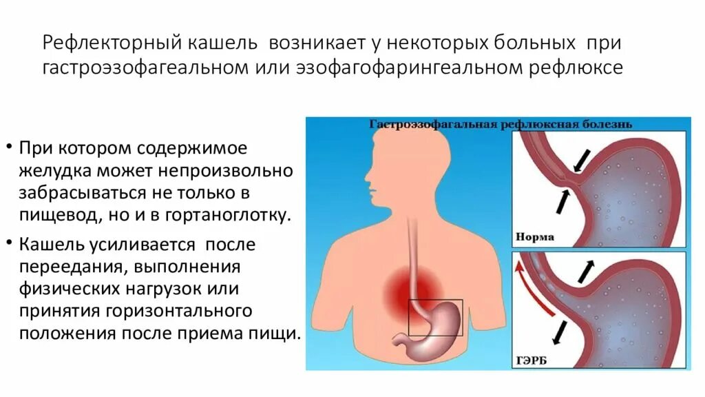 Кашель появляется при заболевании. Рефлекторный кашель. ГЭРБ кашель. Кашель при Гастроэзофагеальная рефлюксная болезнь. Кашель при пищеводном рефлюксе.