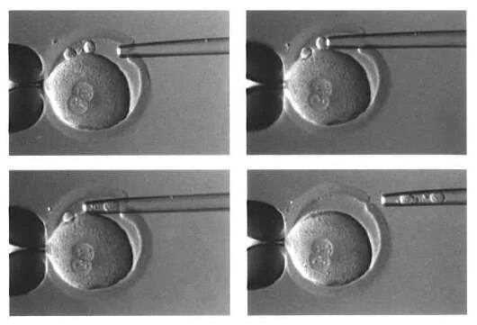 Подсаживали 2 эмбриона. Биопсия трофэктодермы эмбриона. Подсадка 2 эмбрионов при ИКСИ. Преимплантационная генетическая диагностика эмбрионов. ПГД эмбриона.