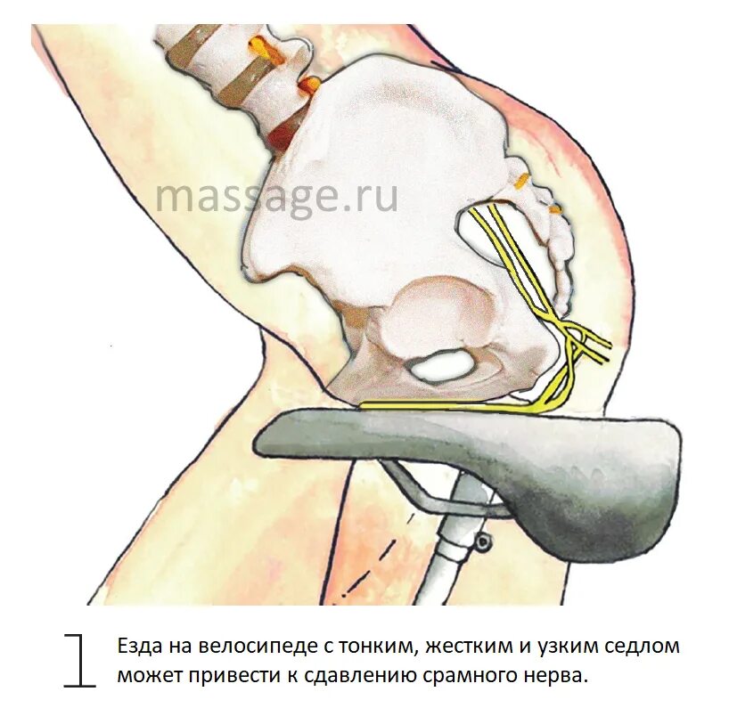 Невропатия полового нерва