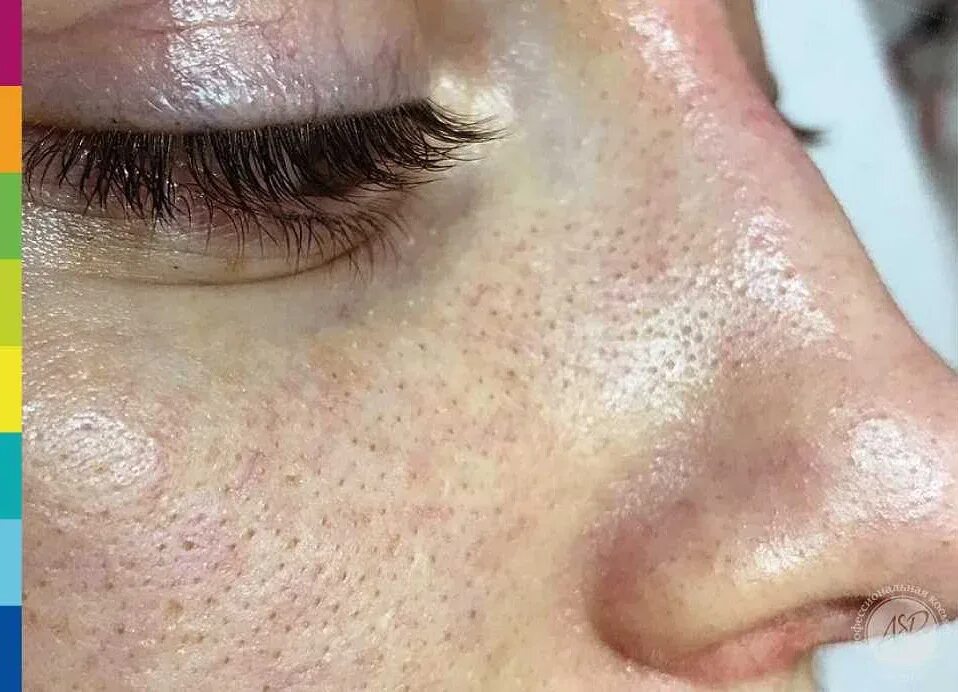 Как избавиться от белых на лице