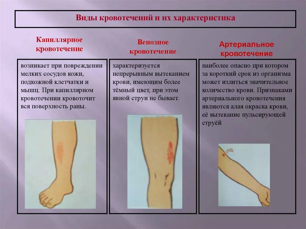 Кровотечение виды кровотечений. Наиболее опасный вид кровотечения. Характеристика видов кровотечений. Кровотечения характеристика и первая помощь