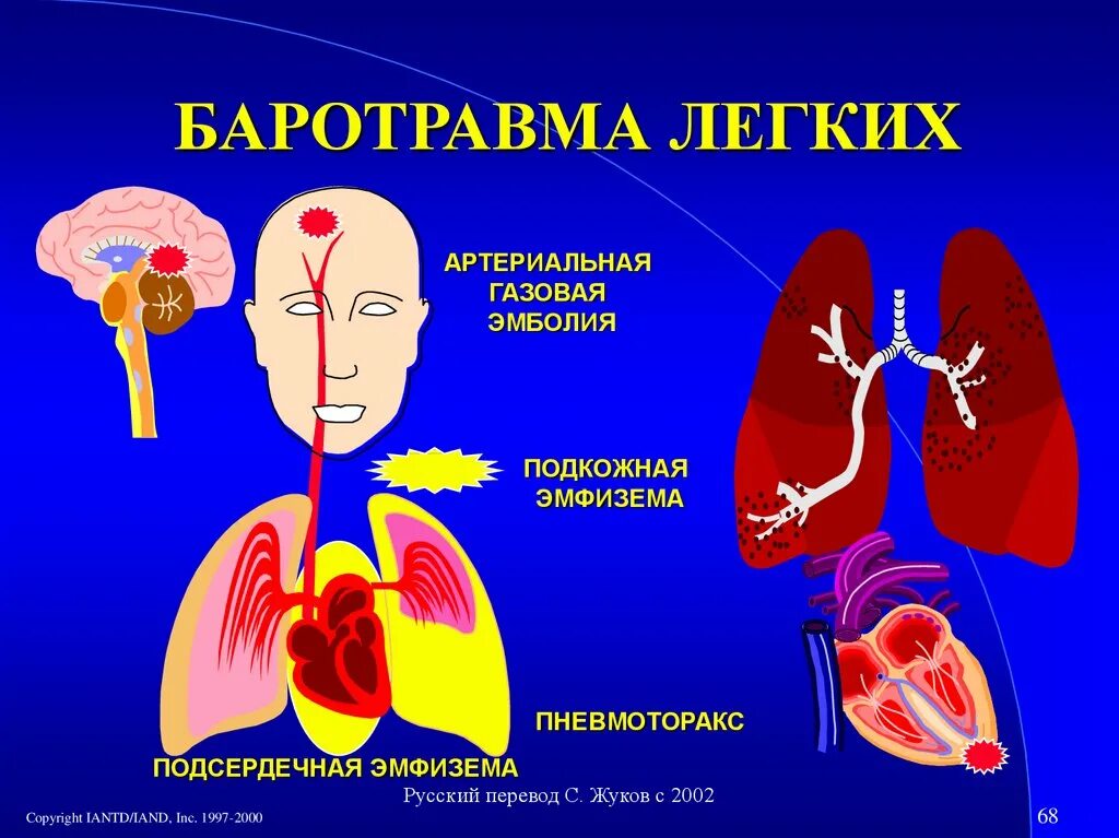 Баротравма легких. Барот травма. Баротравма легких презентация. Баротравма это простыми словами в медицине