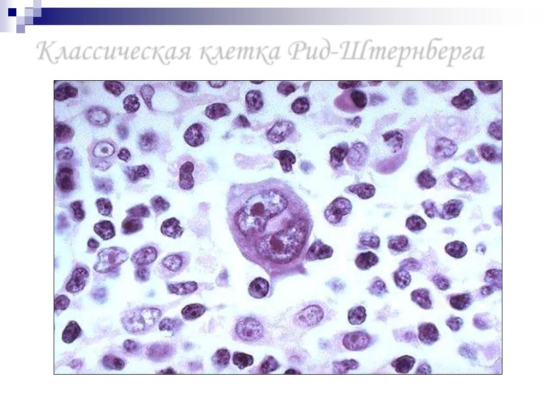 Рид штернберга. Клетки Рид-Березовского-Штернберга. Клетки Березовского-Штернберга гистология. Морфология клеток Рид-Березовского-Штернберга. Лимфома Ходжкина клетки Березовского-Штернберга-Рид.