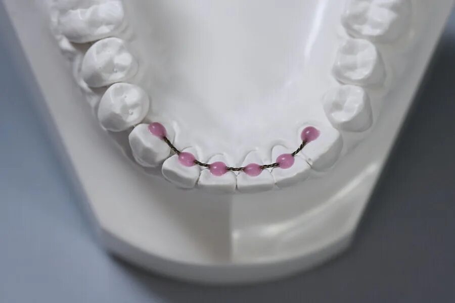 ортодонтическая капа элайнеры. ретейнер ортодонтический проволочный. ретейнер ортодонтический. ретейнер ортодонтический проволочный. несъемный проволочный ретейнер.