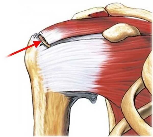 Лечение частичного разрыва мышц. Ротаторная манжета плечевого сустава мышцы. Сухожилия ротаторной манжеты. Сухожилия ротаторной манжеты плечевого сустава. Сухожилия подосной мышцы плеча.
