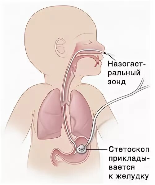 Зонд в нос. Назогастральный зонд у ребенка. Зондовое кормление детей. Желудочный зонд через нос. Питание ребенка через зонд.