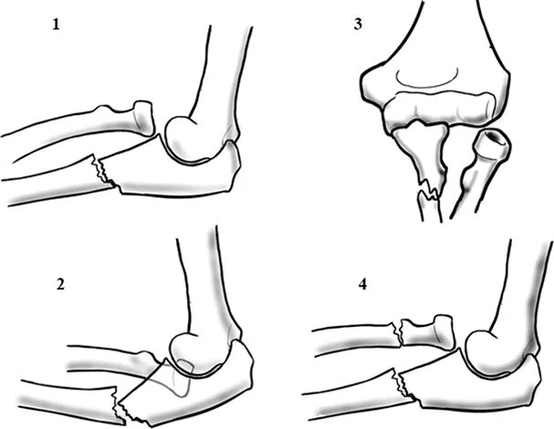 Перелом вывих монтеджи. Перелом вывих монтеджи. Переломовывих монтеджи. Перелом монтеджи классификация. Вправление перелома монтеджм.