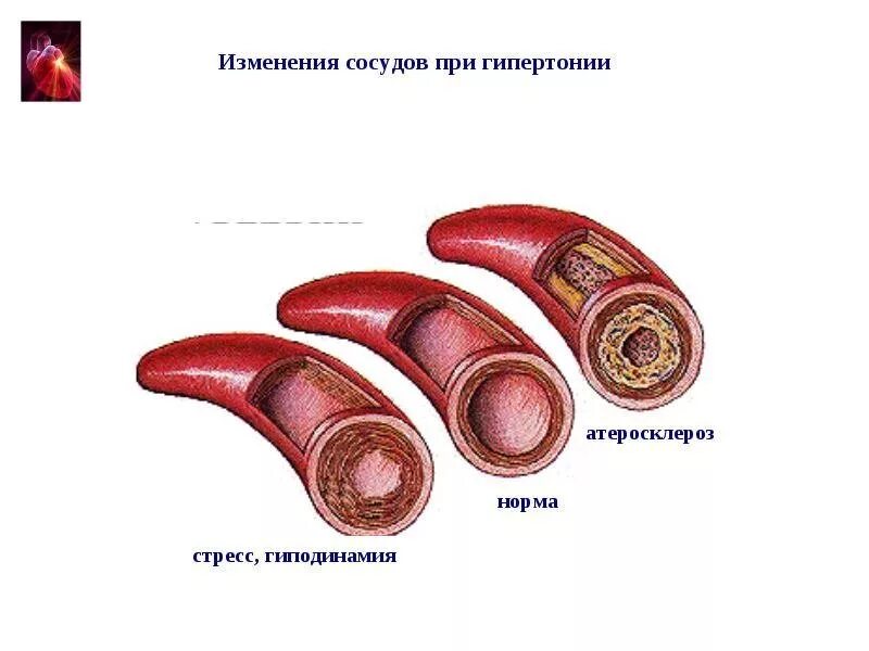 Давление при атеросклерозе сосудов. Гипертоническая болезнь изменения в сосудах. сосуды при гипертонической болезни. изменения сосудов при гипертонии.