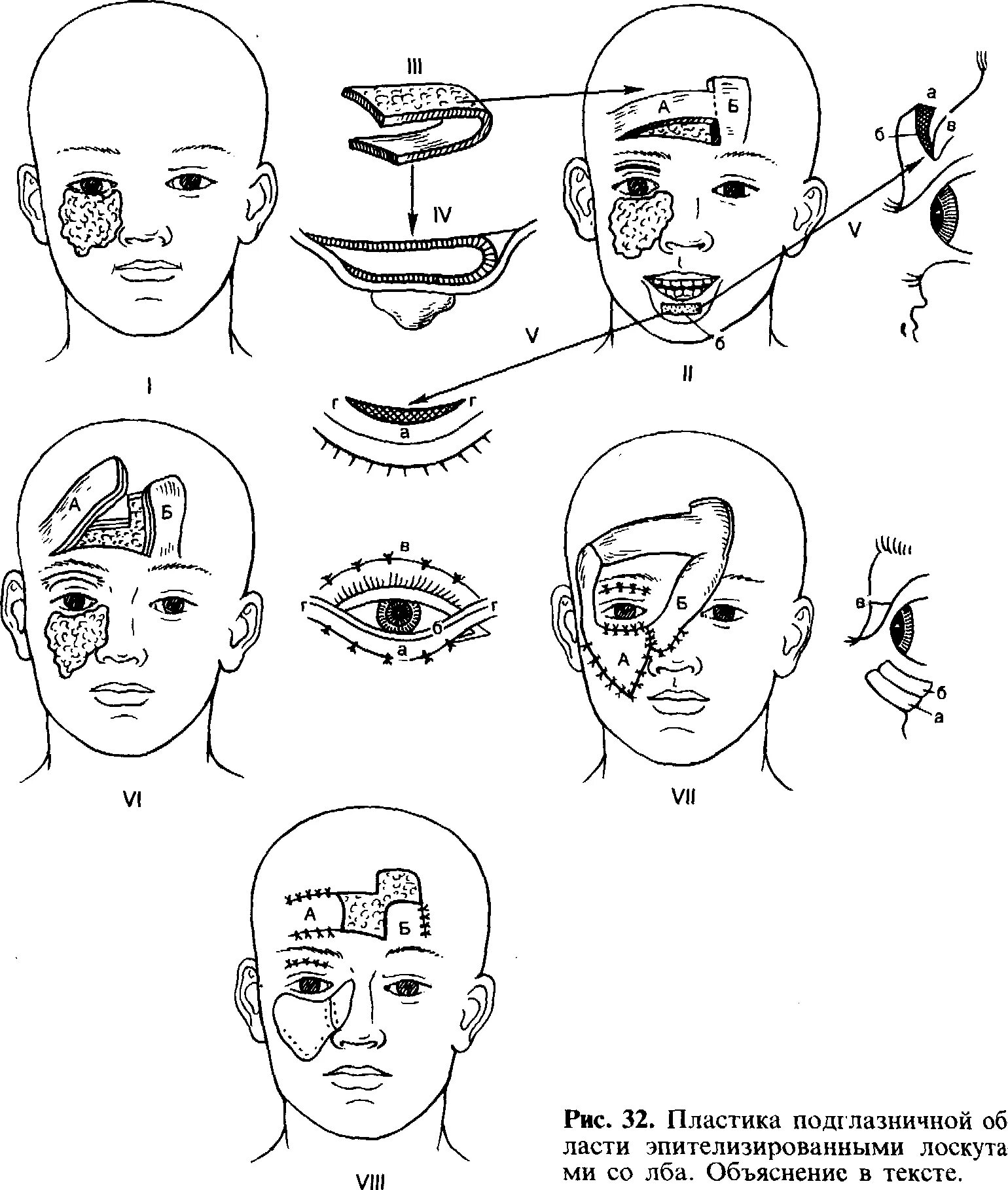 Пластика перемещённым кожным лоскутом. Пластическая хирургия схема. Восстановительная хирургия ЧЛО пластика кожным лоскутом.