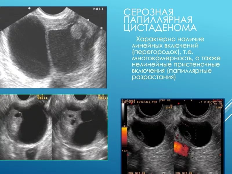 Текалютеиновые кисты яичников. Текалютеиновая киста яичника УЗИ. Муцинозная цистаденома яичника на УЗИ. Киста яичника с перегородками