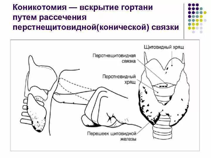 Коникотомия анатомические ориентиры. Коникотомия. Показания. Методика выполнения.. Коникотомия схема операции. Пункционная коникотомия у детей.