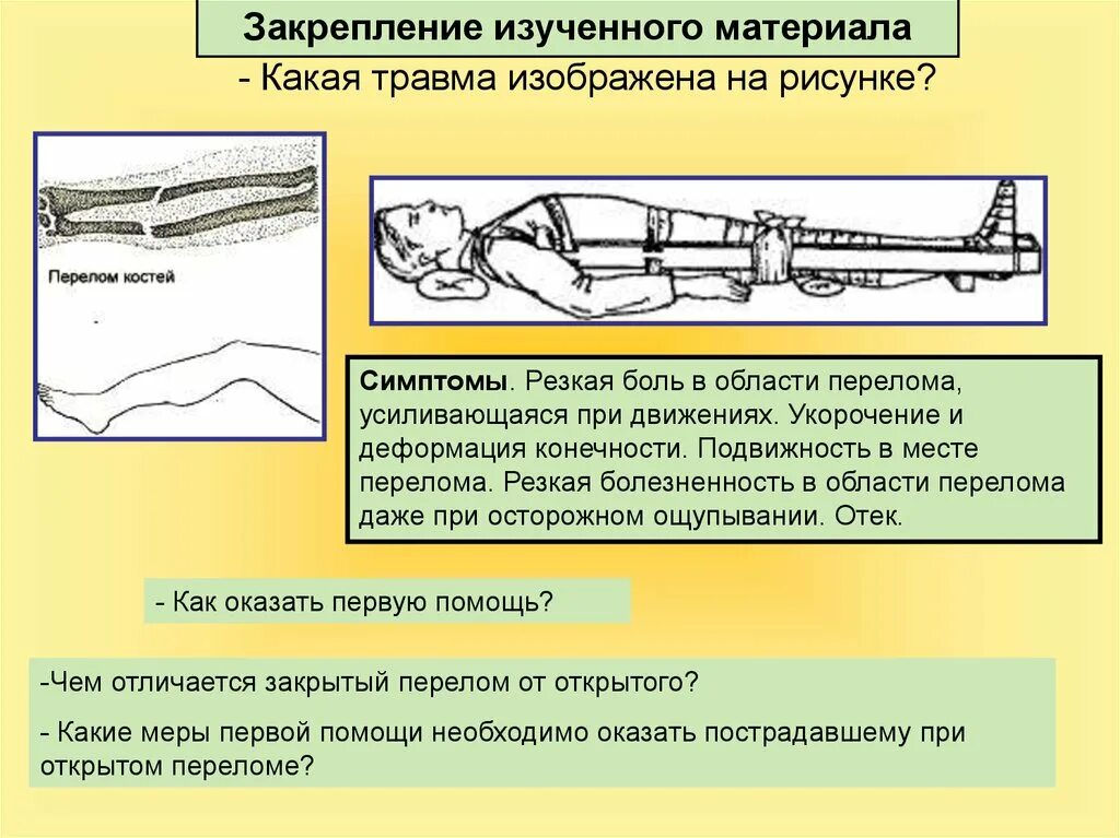 Доврачебная помощь при переломах вывихах растяжениях. Меры первой помощи при открытом переломе. первая при закрытом переломе биологии. первая помощь при переломах костей скелета. тип несчастного случая при переломе.