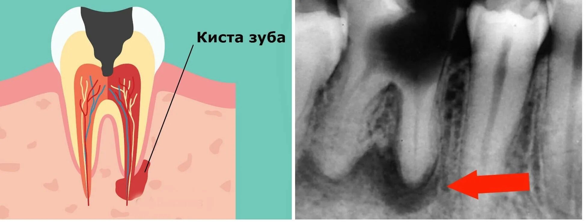 Как отличить зубную боль от воспаления. Свищевой ход периодонтит. Периодонтальный абсцесс.