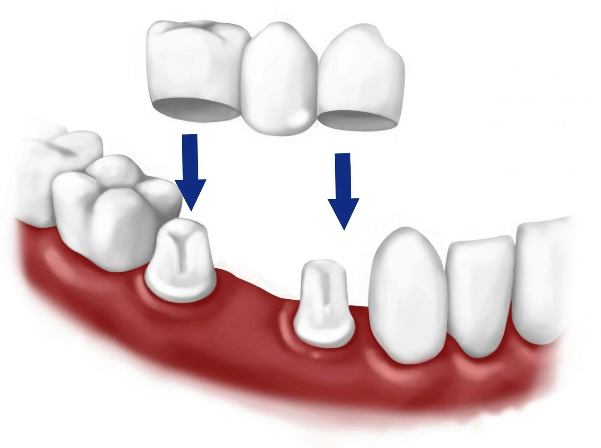 Консольный мост зубной. Мостовидный протез на 4 зуба. На какие зубы ставят мосты. Мостовидные зубные протезы. Мостовидный протез на 4 зуба передних нижних зубов.