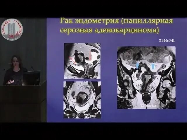 Гиперплазия эндометрия мрт. Мрт эндометрия